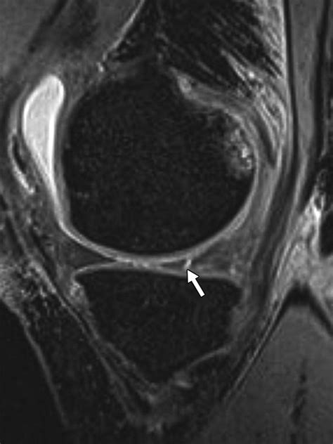 Meniscal Tear Configurations Categorization With 3d Isotropic Turbo