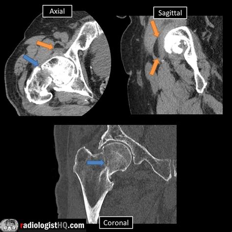 Lipohemarthrosis R Radiology