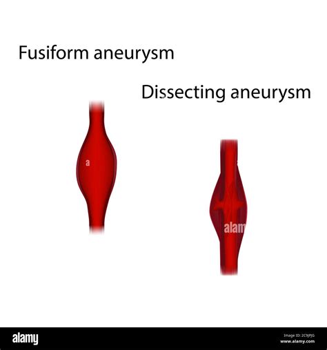 Fusiform And Dissecting Aneurysms Hi Res Stock Photography And Images