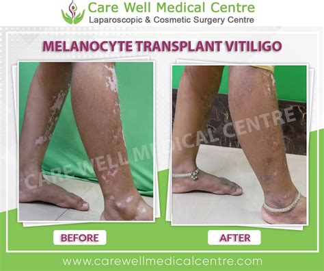 Melanocytes Transplantation In Delhi Melanocyte Transplant Surgery For Vitiligo Care Well