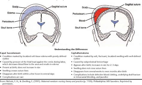 Caput Succedaneum Vs Cephalohematoma Why Does My Baby's Head Look