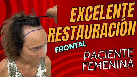 Excelente Restauaraci N Frontal En Paciente Femenina Dr Bruno