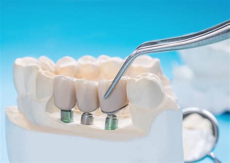 Which Dental Restorations Are Different From Dental Crowns