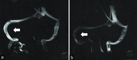 Magnetic Resonance Mr Venography Showing Alteration Of The Signal