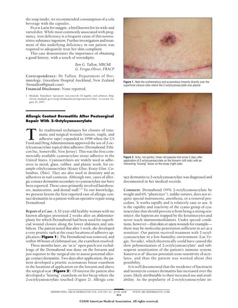 Allergic Contact Dermatitis After Postsurgical Repair With 2