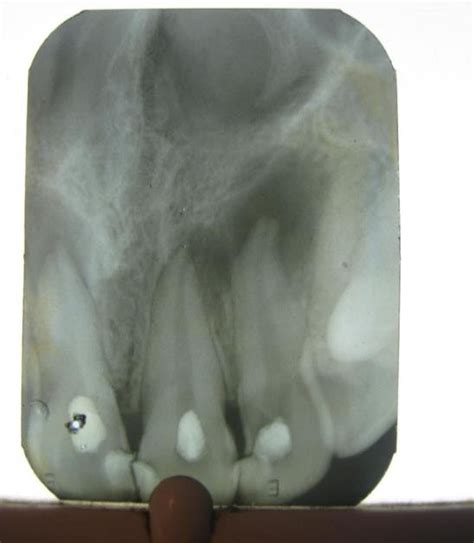 Pre Operative Radiograph Of Teeth Restored With Composite Resin Showing