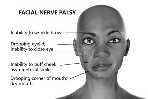 Physiotherapy for Facial Palsy. Facial Palsy is a paralysis on one side… | by St. Joseph's ...