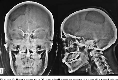 Figure From A Unique Case Of Calvarial Hemangioma Semantic Scholar