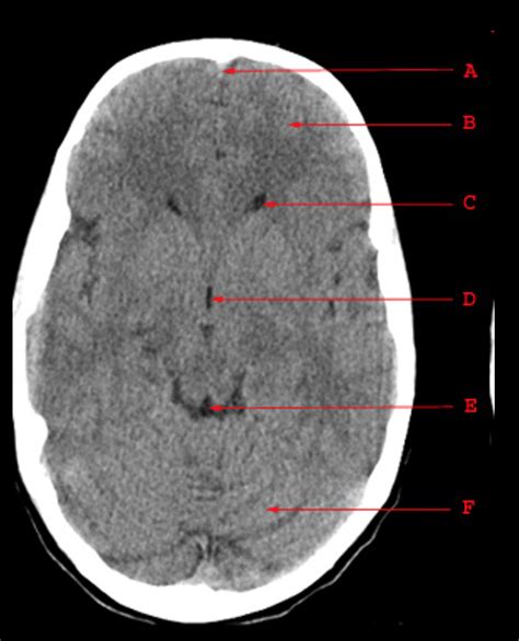 CT Head Anatomy Part 4 Diagram | Quizlet