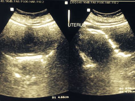 Emphysematous Cystitis Gas In Bladder A Rare Urological Emergency