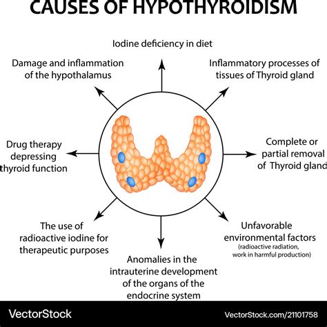 Causes of thyroid hypothyroidism infographics Vector Image