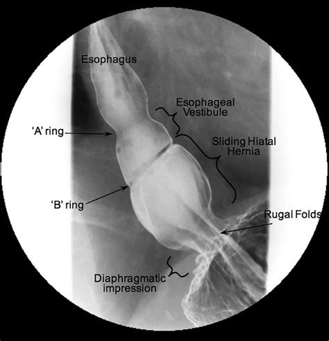 Paraesophageal Hernia Barium Swallow