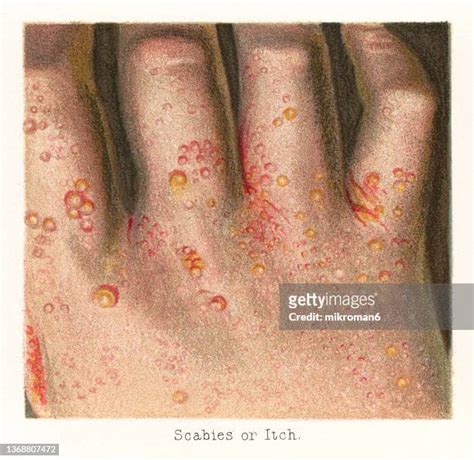 Scabies Skin Photos and Premium High Res Pictures - Getty Images