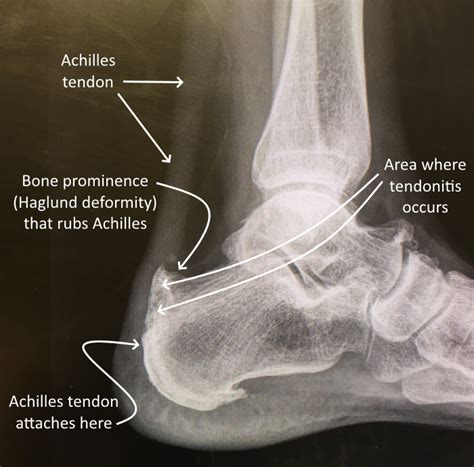 Achilles Tendonitis Drwolgin