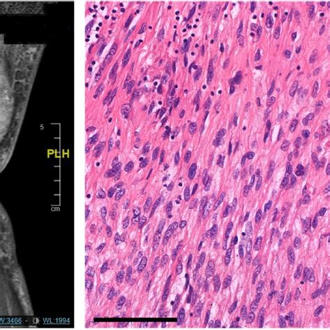 Exemplary Images Of A High Grade Sarcoma The Left Image Shows The