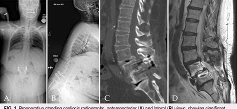 Figure From Oblique Anterior Column Realignment With A Mini Open