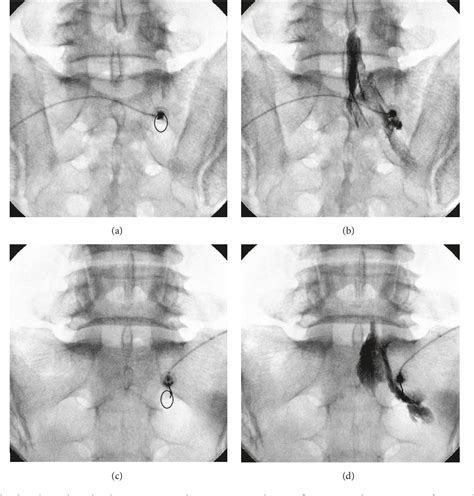 Figure From Comparison Of Incidences Of Intravascular Injection