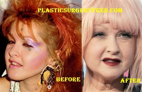 Cyndi Lauper Plastic Surgery - Plastic Surgery Feed