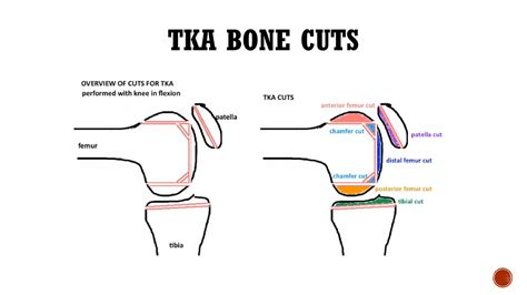 total knee replacement arthroplasty pptpptx