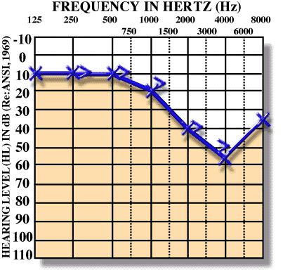 Audiograms & Hearing Loss - DHH Education