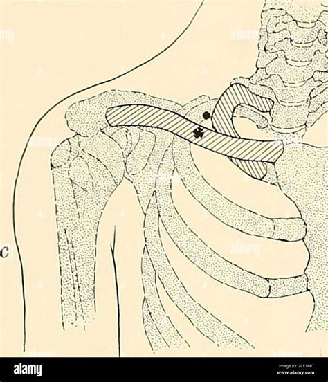 Anestesia Regional Su Aplicaci N T Cnica Y Cl Nica Fig