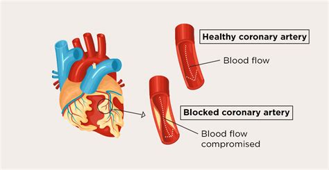 Qi Stagnation And Blood Stasis Type Coronary Heart Disease Part 1