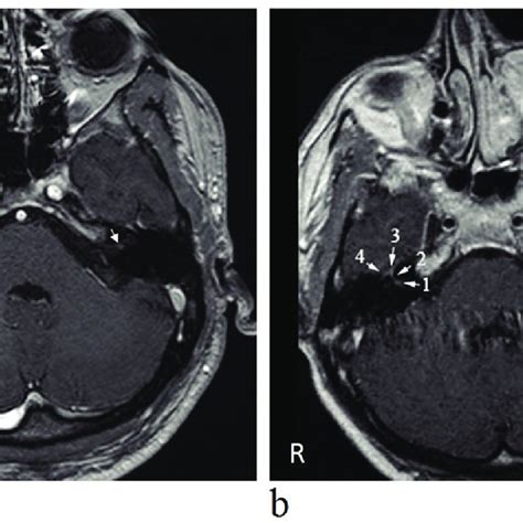 Contrast Enhancement On T1 Weighted Axial Mri Images A Contrast