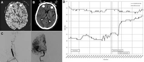 Cerebral Near Infrared Spectroscopy Stroke