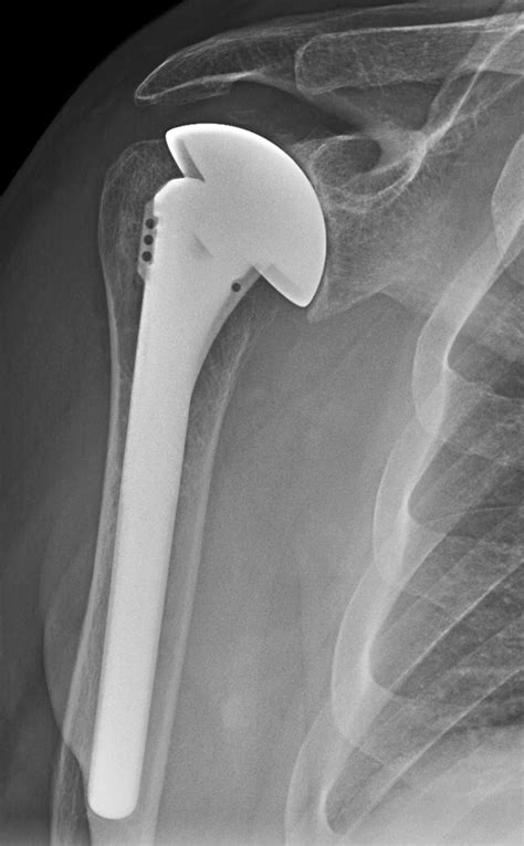 UW Shoulder and Elbow Academy: Shoulder joint replacement - humeral ...