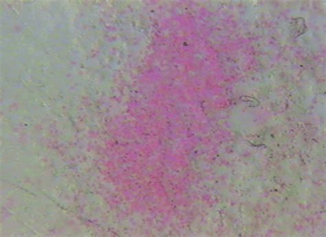 Prussian Blue Staining Of Bone Marrow Biopsy Without Any Evidence Of