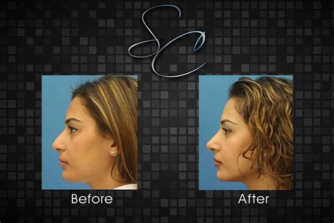 Rhinoplasty – Southern California Surgical Center