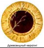 Кератит