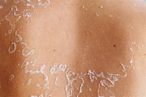 Premium Photo Shedding Skin After Sunburn On Back Reminiscent Of Map