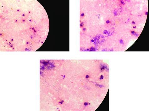 Left Calf Centesis Disseminated Nocardia Nova Left Calf Centesis