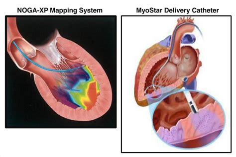 Stem Cells In The Treatment Of Heart Failure MyHeart