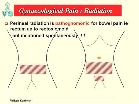 Pain symptoms of endometriosis - gynsurgery.org