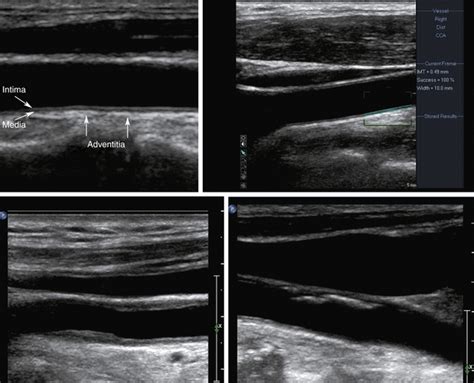 The Role Of Ultrasound In The Management Of Cerebrovascular Disease