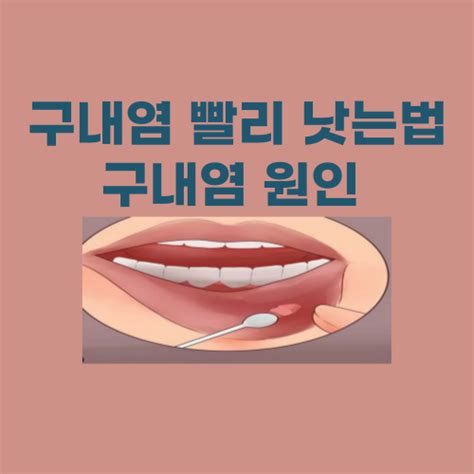 아기 구내염 왜 생길까 구내염 빨리 낫는법 완벽정리 건강한 생활 인사이트