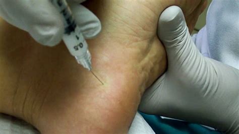 Heel Spur Or Plantar Fascia Injection Youtube