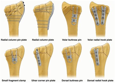 Fragment Specific Fixation Of Distal Radius Fractures Musculoskeletal Key