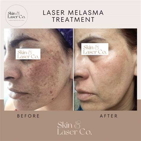 Melasma/Pigmentation - Skin Laser Co