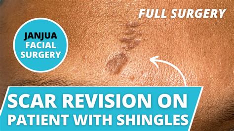 Scar Revision Live Surgery On Patient With Shingles On Forehead Dr