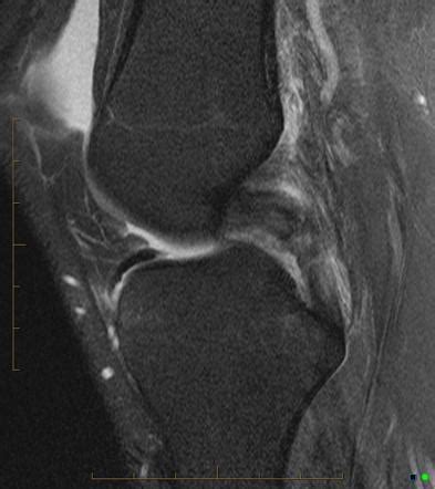 Posterior Cruciate Ligament Mri