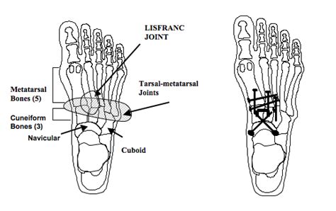 Midfoot Arthrodesis - Foot Pain Treatment in Roswell, GA