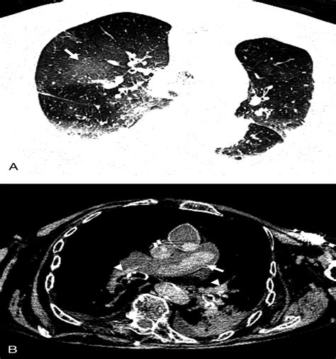 Reliable Postmortem Computed Tomography Scan Diagnosis Of Co The