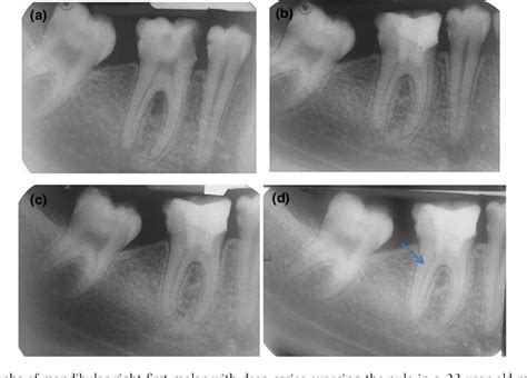 Figure 1 From Outcome Of Full Pulpotomy Using Biodentine In Adult