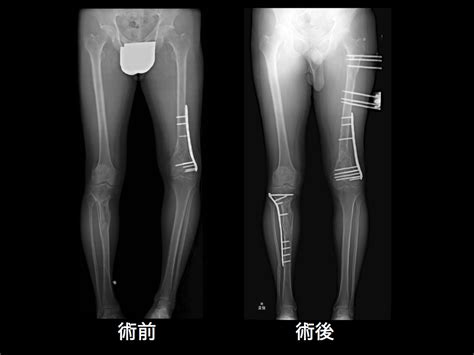 難治骨折診｜帝京大学医学部 整形外科学講座