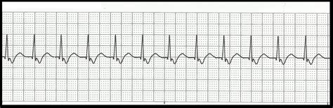 Float Nurse: EKG Rhythm Strip Quiz 98: Junctional rhythms