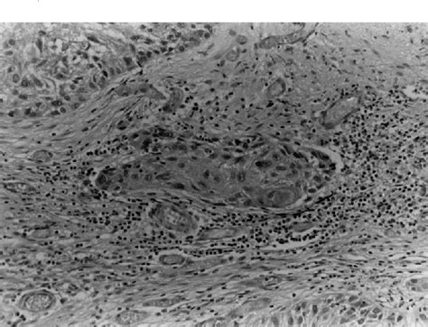 Figure 2 From Temporal Bone Histopathology Case Of The Month Isolated