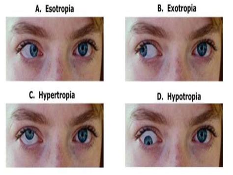 Accommodative esotropia